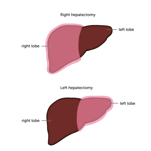 types-of-surgery-liver-cancer-uk