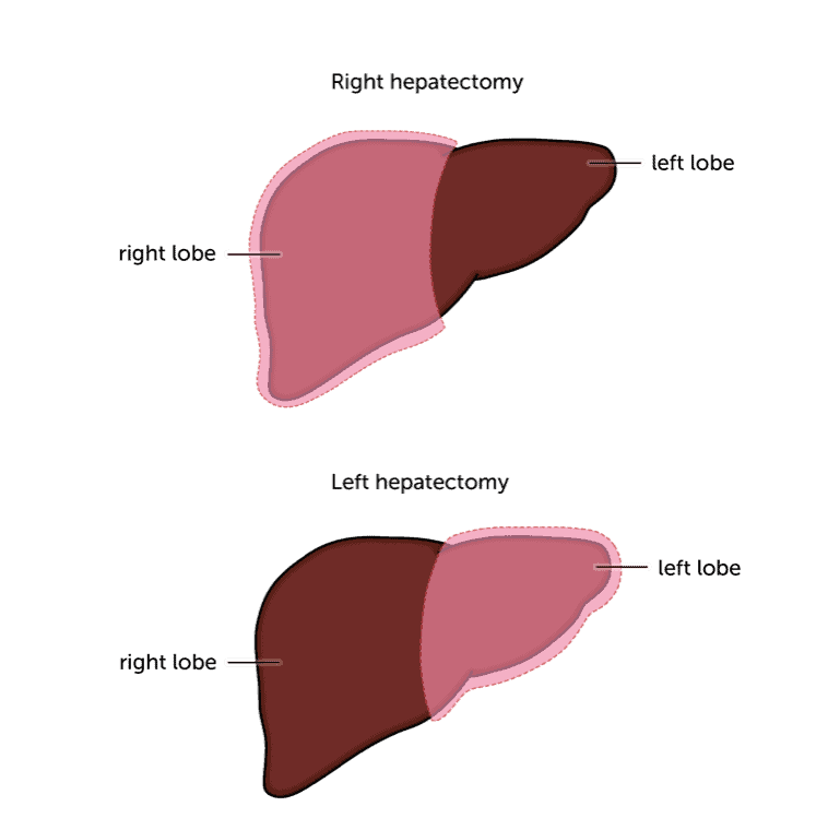 Types Of Surgery Liver Cancer Uk